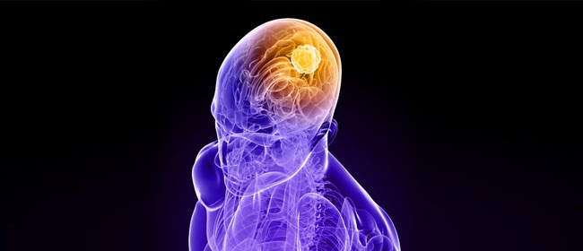 brain cancer