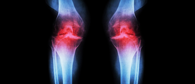 knee joint xray