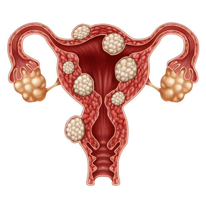 SHR # 2365 :: A New Way To Treat Uterine Fibroids