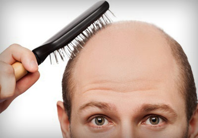 a man with hair loss problem