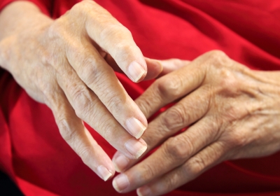 arthritis